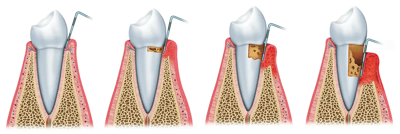 Parodontologija bolesti slika postupka lecenja