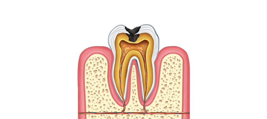 Ilustovana slika karijesa na zubu