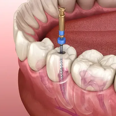 Lecenje korena zuba postupak slika 1