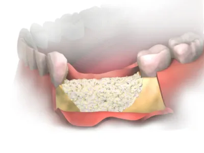 Oralna hirurgija zubna kost slika 1